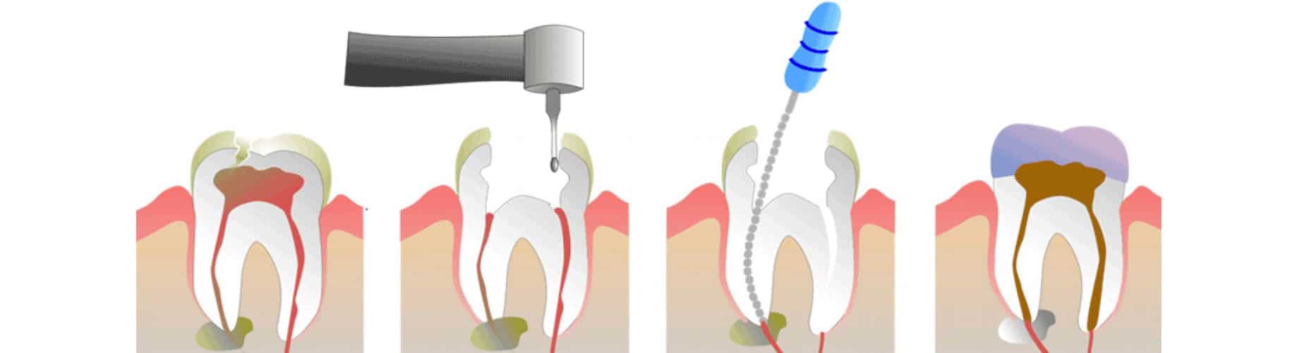 Terapia endodontica 